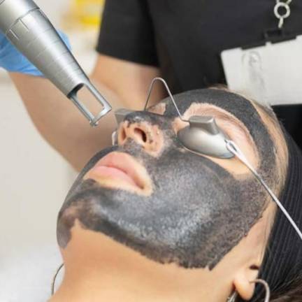 CARBON LASER PEEL