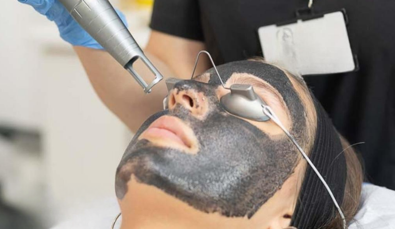 CARBON LASER PEEL CARBON LASER PEEL