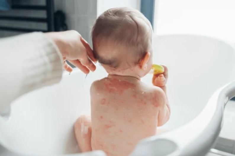 Child Skin Disorders